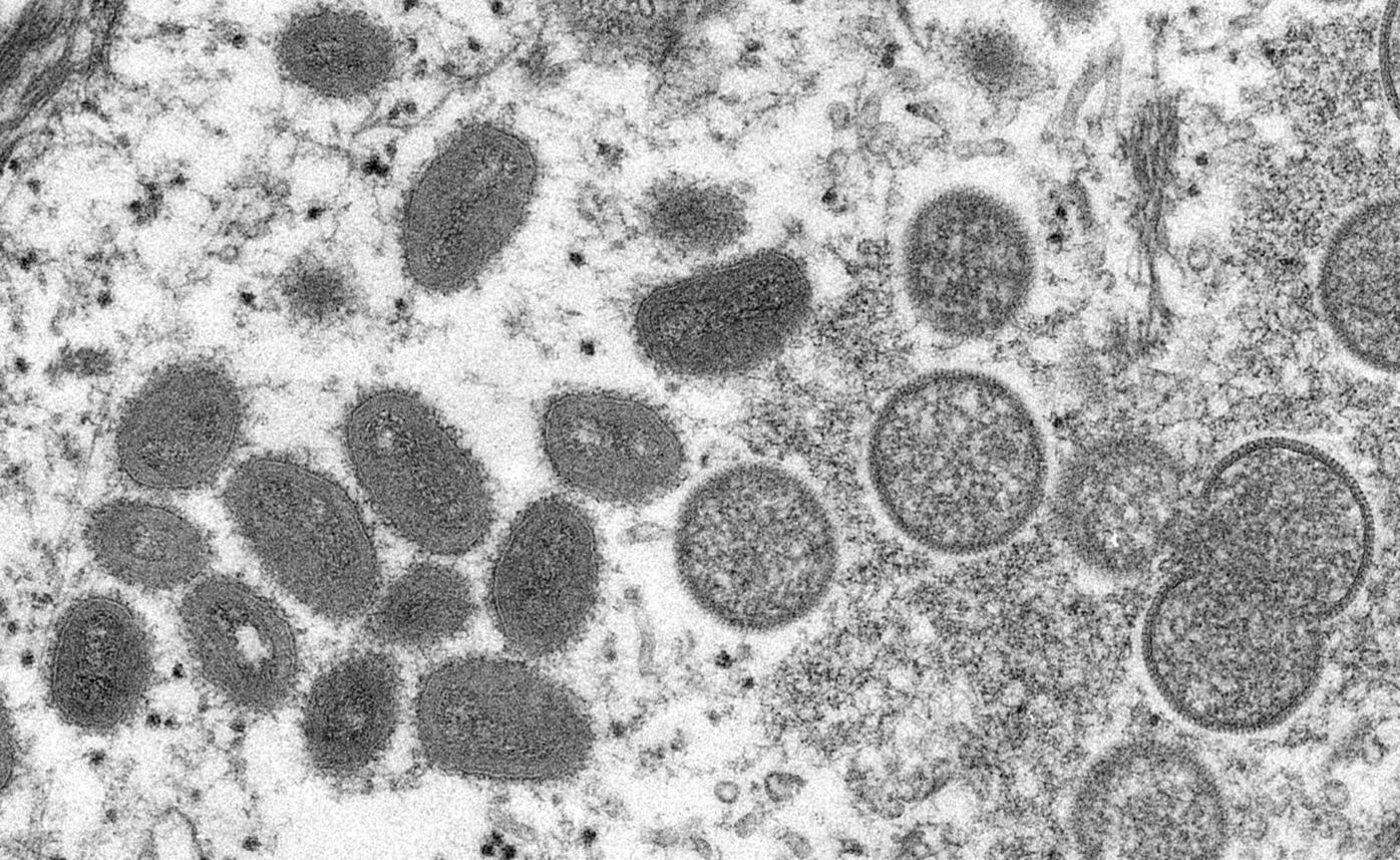 Almost 90% of US mpox-related deaths were inBlack men, and nearly all had weakened immune systems,CDC reports