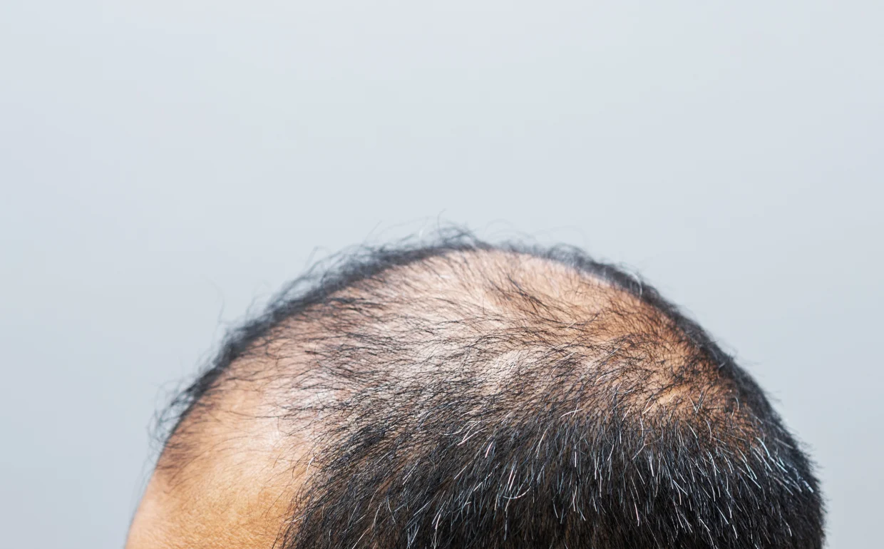Minoxidil, drug that treats thinning hair, may be in short supply