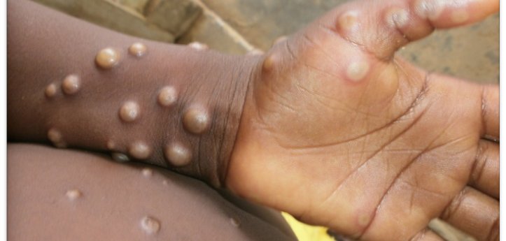 Mpox infections double last year’s rate in U.S.