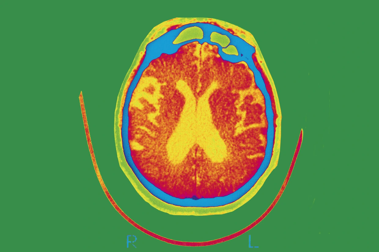 Some cases of Alzheimer’s caused by two copies of a single gene