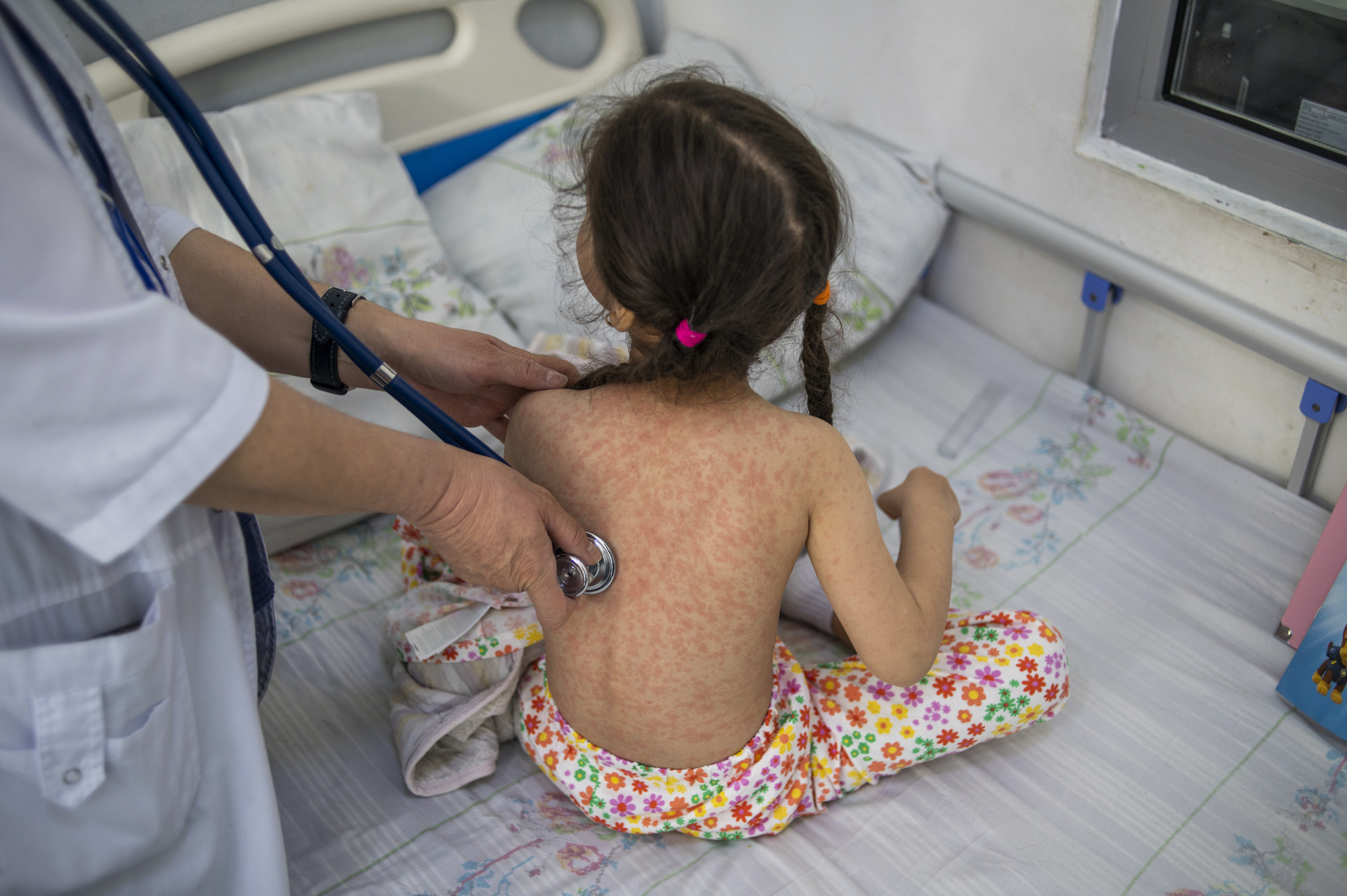 Measles cases surge worldwide, infecting 10.3 million people in 2023: WHO