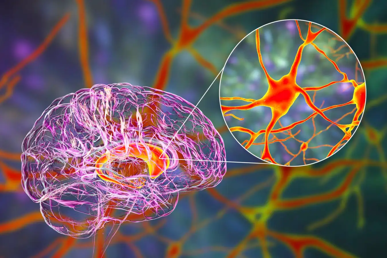 Preliminary but promising gene therapy shows 75% reduction in Huntington’s disease progression