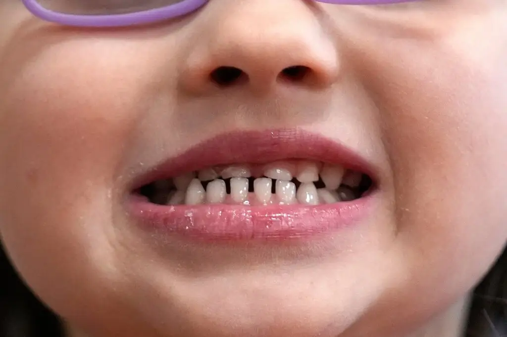 FDA restricts use of kids’ fluoride supplements, citing emerging health risks